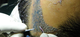 Hair Transplant In Delhi
