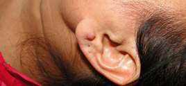 Keloids treatment in delhi