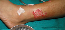 Vitiligo Treatment In Delhi