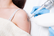  Laser Tattoo Removal in Delhi, dermatologist in Delhi