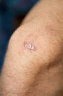  Keloid Therapy by Experts, Dermatologist In Delhi