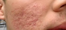 dermatologist in Delhi - The agony  of Acne scars