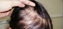 dermatologist in Delhi - Hair Loss and hair fall is very common now a days in younger age group.