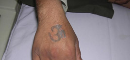 dermatologist in Delhi - Tattoo  can be removed by Q Switched Nd Yag Laser in 3-4 sittings.