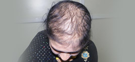 dermatologist in Delhi - Hair Fall