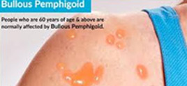 dermatologist in Delhi - Bullous Pemphigoid