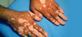 dermatologist in Delhi - Vitiligo