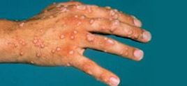 dermatologist in Delhi - Viral Warts: Common Skin Lesions