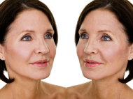 Anti Aging Therapy, Dermatologist in Delhi