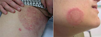 Fungal infections treatment in delhi, Fungal infections Symptoms