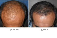 Hair Transplant @ 17/-Rs per hair follicle