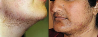hirusitism, dermatologist In Delhi
