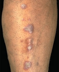 Lichen planus, dermatologist In Delhi