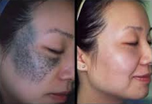 Q Switch ND Yag Laser, Tattoo, Freckles, Lentigines Removal Clinic In Delhi