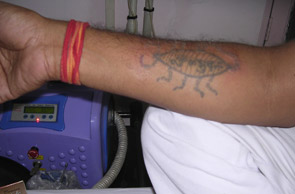 Tattoo Removal with expert dermatologist in delhi